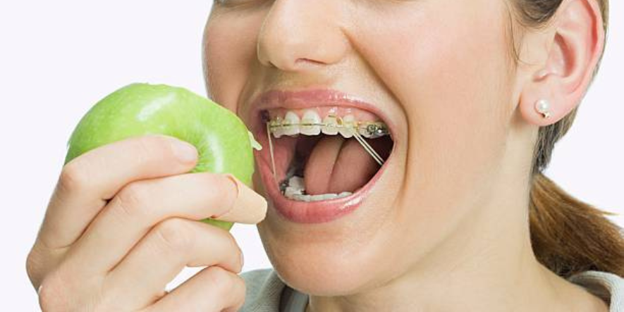 Soft Foods for Braces